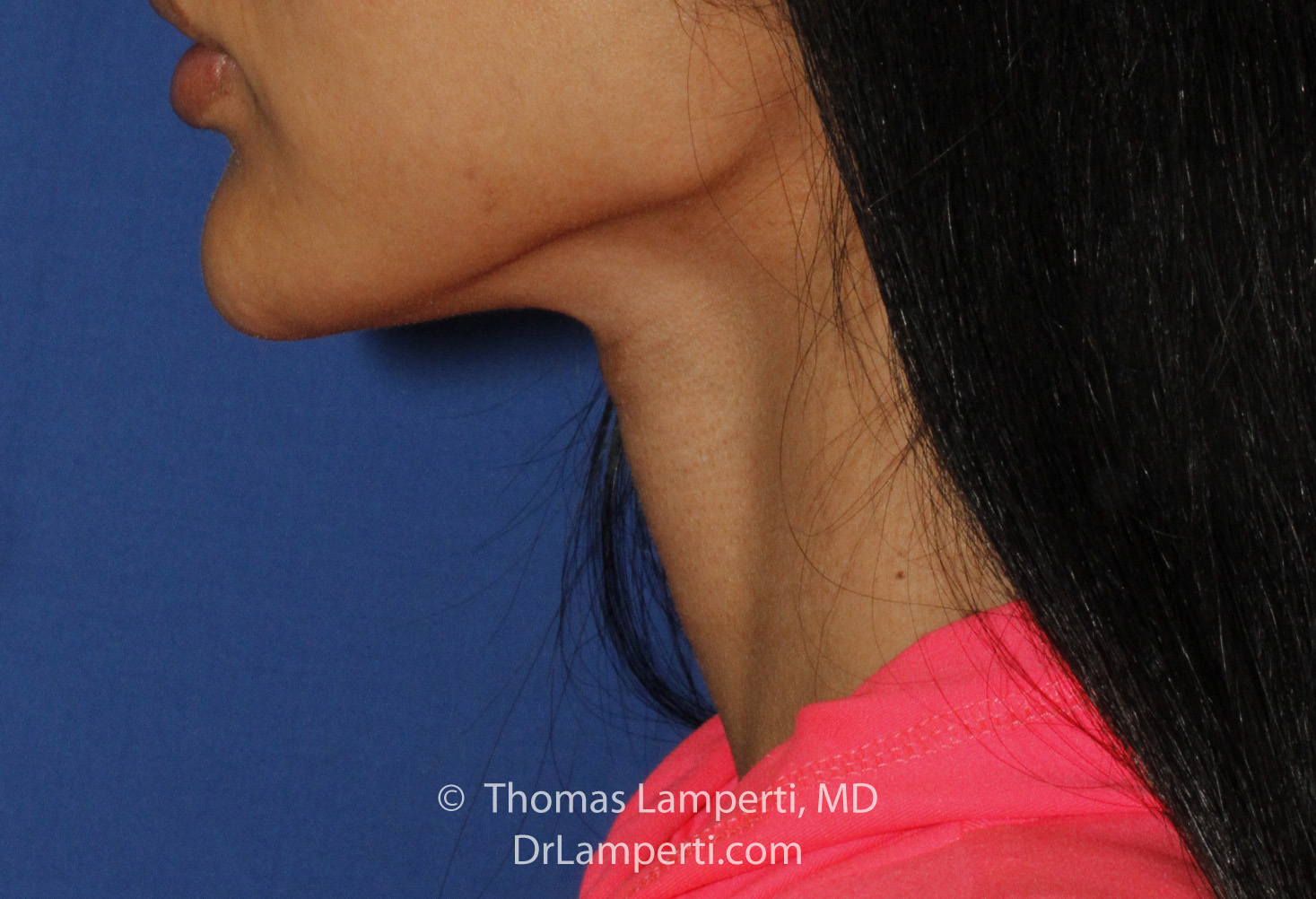 Tracheal Shave After L Profile
