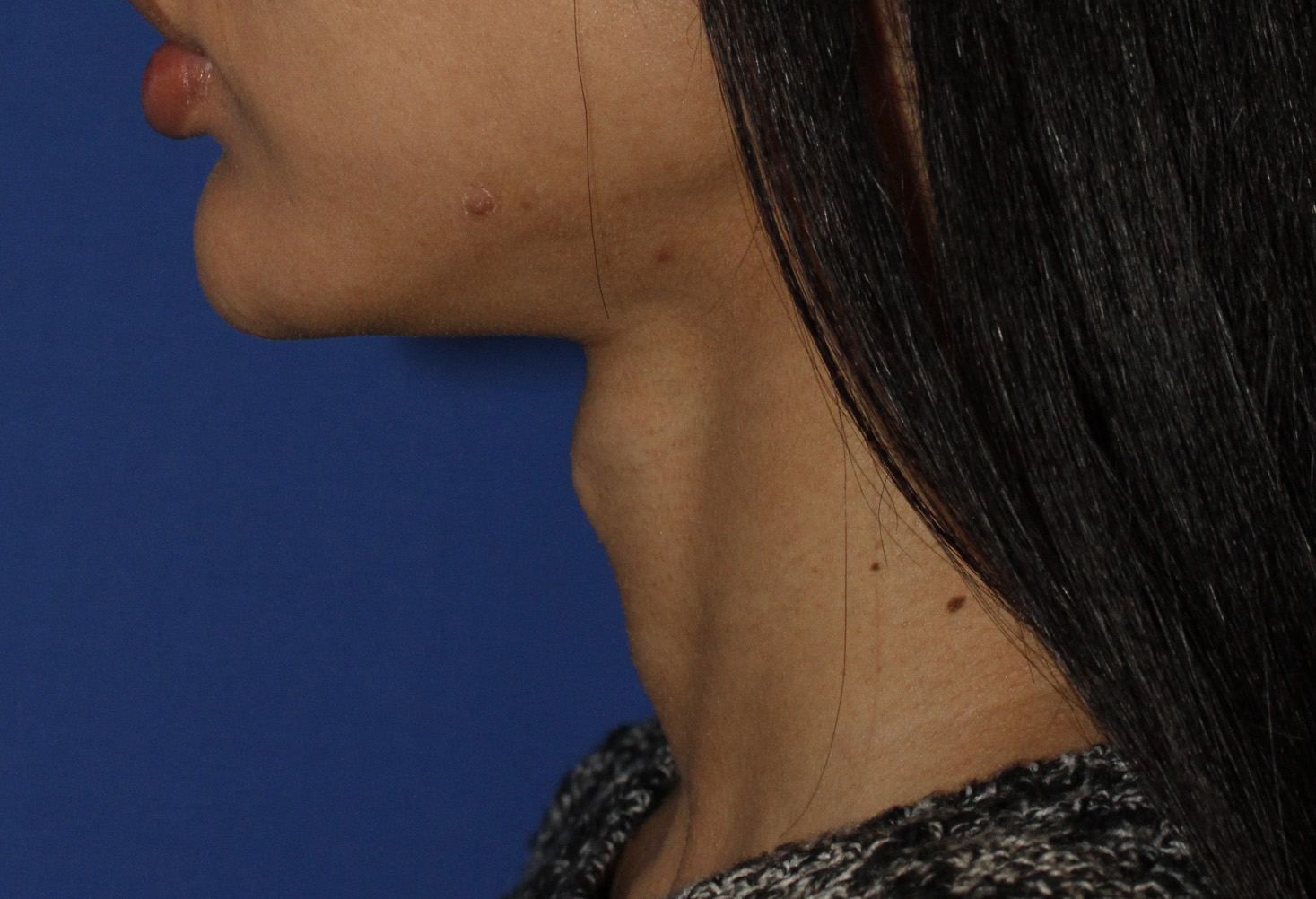 Tracheal Shave Before L Profile