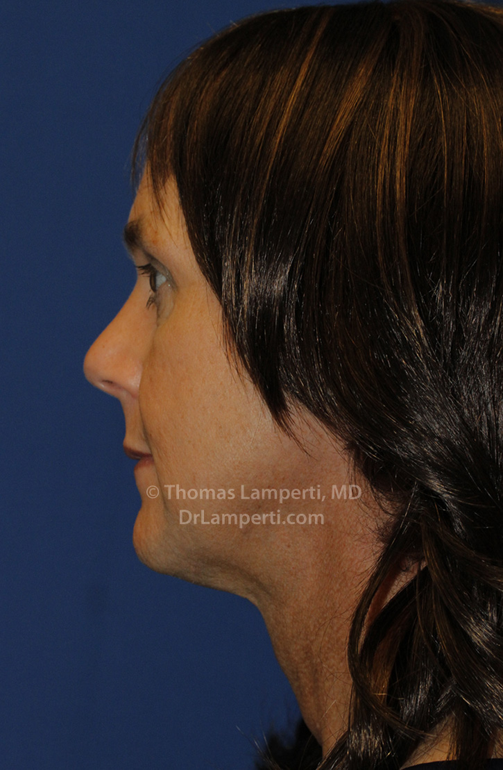 Tracheal Shave After L Profile