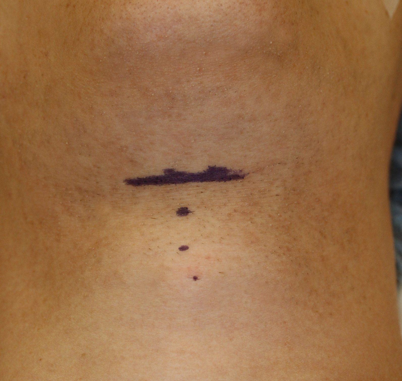 Tracheal Shave Preop Skin Markings