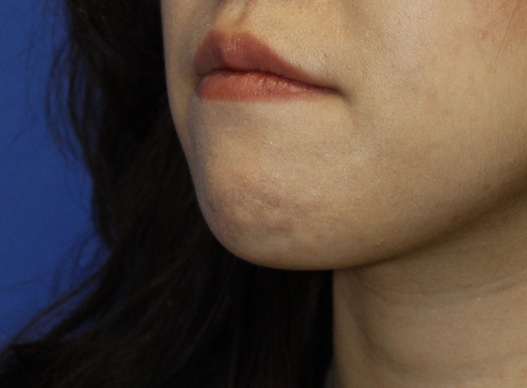 Chin Reduction Before L Oblique