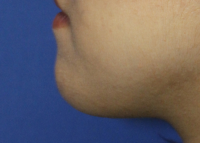 Chin Reduction Before L Profile