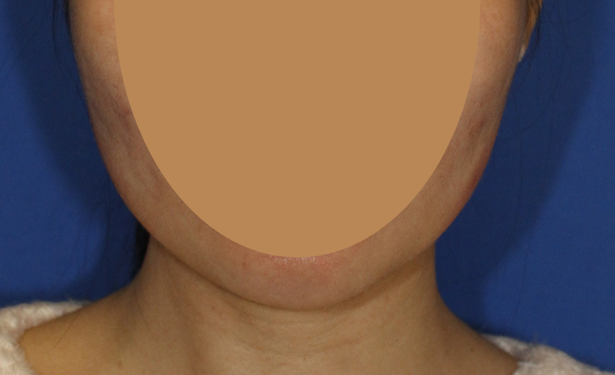 Masseter Muscle Botox Before