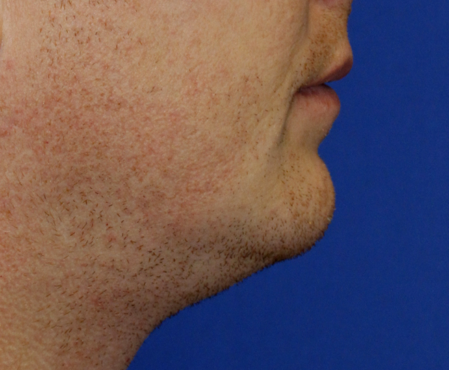 Chin Reduction R Profile Before