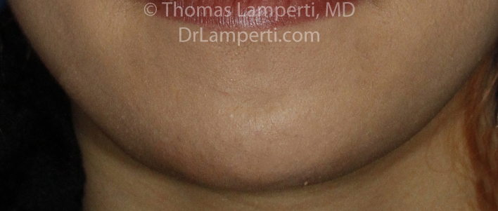 Chin Reduction After Frontal