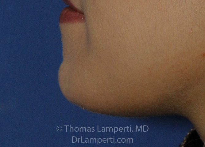 Chin Reduction After L Profile