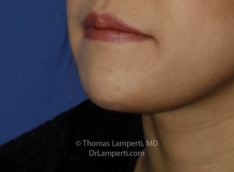 Chin Reduction After L Oblique