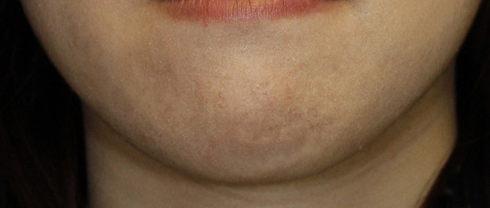 Chin Reduction Before Frontal