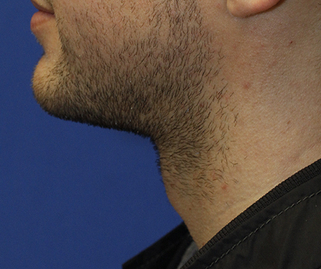 _mg_3452-crop-postop-profile.jpg