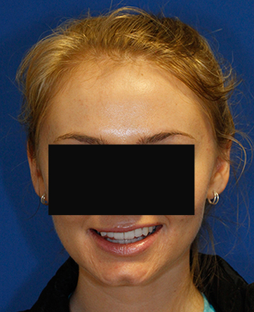 Frontal photo showing a prominent cleft chin before surgical removal. www.drlamperti.com