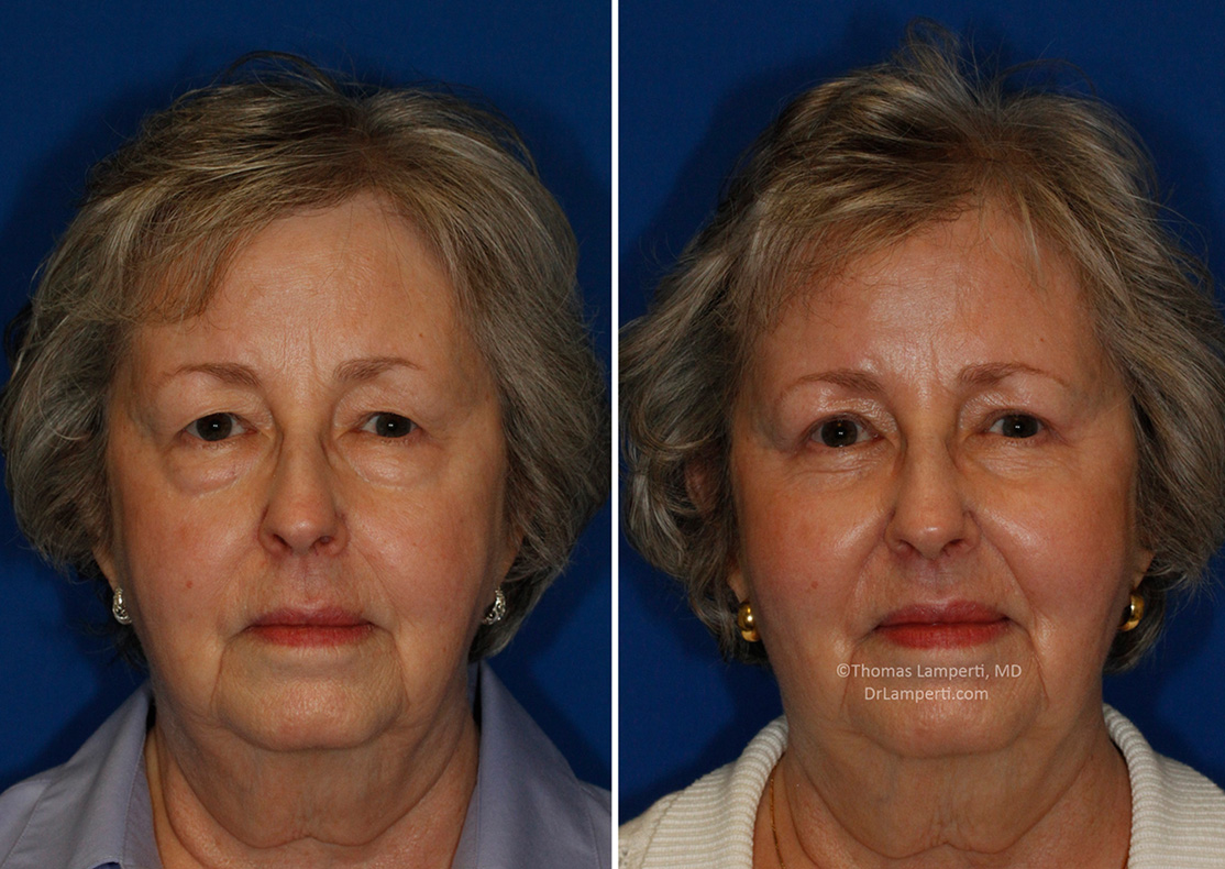 Blpeharoplasty patient 43 frontal before and after montage photos