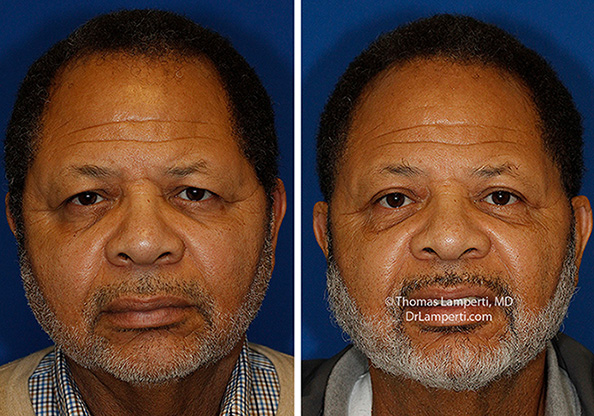 Male Blepharoplasty patient 69 before and after montage