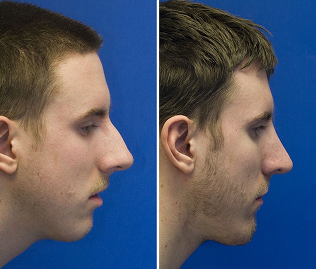 How To Make A Nose Look Smaller With Chin Implantation Seattle Facial 