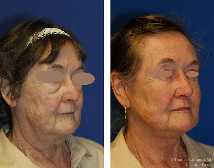 Facelift patient 11 with fat grafting lower blepharoplasty right oblique montage