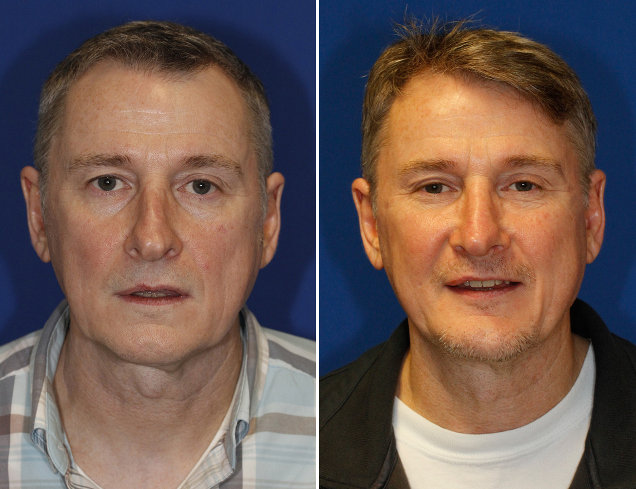 Before and 15 months After chin implant photo