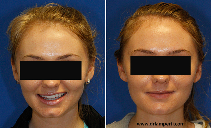 Before and after cleft chin removal frontal photos. www.drlamperti.com