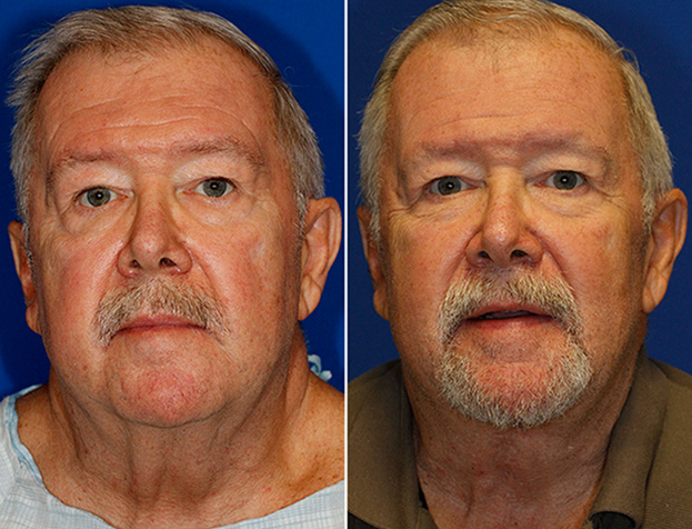 Grecian Urn direct neck lift frontal view before and after photos. After photo on the right was taken 1 year after surgery.