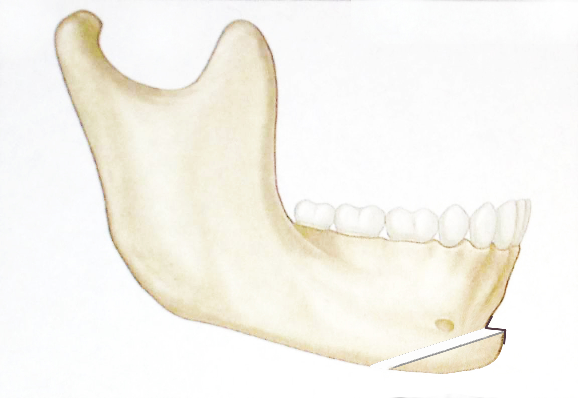 lateral-mandible-retrusive-chin-with-advanced-mentum-and-plate.jpg