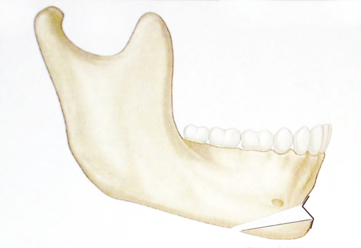 lateral-mandible-retrusive-chin-with-anterior-and-inferior-advancement-of-mentum-and-plate.jpg