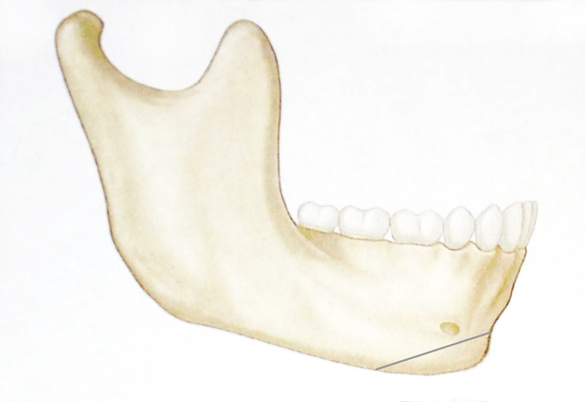 lateral-mandible-retrusive-chin-with-osteotomy.jpg