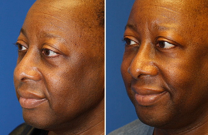 Before and after oblque fat grafting photo showing much improved volume to the tear trough, lower eyelid and midface region