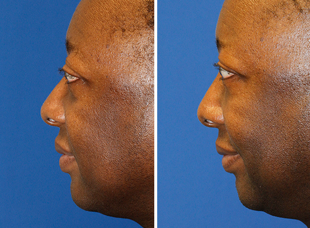 Before and after fat transfer to the midface and lower eyelid to treat severe maxillary hypoplasia