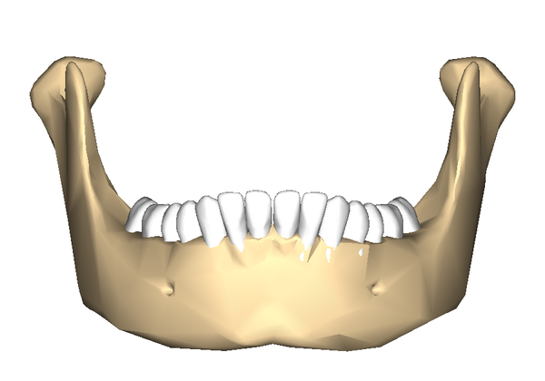 Mandible schematic image showing the chin bone and subtle, typical natural cleft to the chin bone due to the mental tubercles. Used with permission 