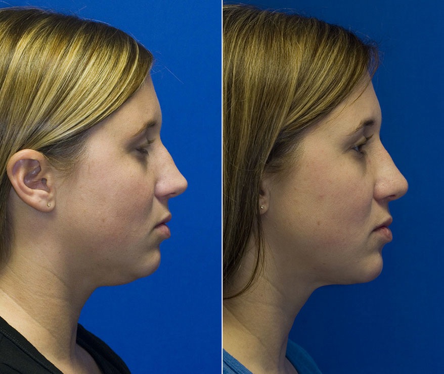 Using neck liposuction to remove a stubborn neck waddle, Seattle Facial  Plastic Surgeon, Dr. Lamperti