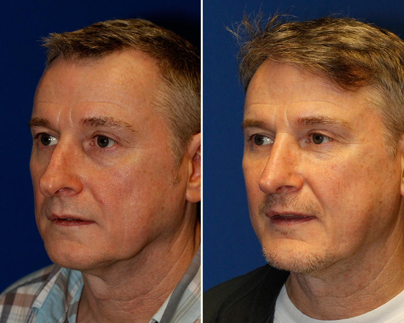 Before and 15 months After oblique chin implant neck lift photo