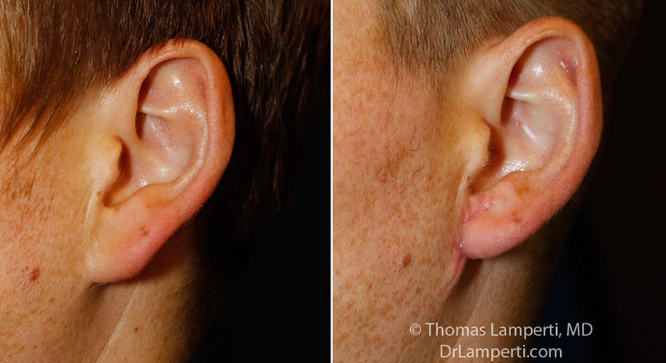 otoplasty-patient-7-l-auricle-detail-montage.jpg