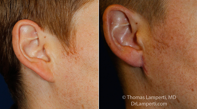 otoplasty-patient-7-r-auricle-detail-montage.jpg