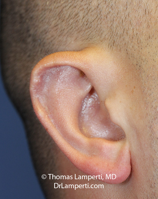 Otoplasty patient 8 right Stahl ear repair 2 months after profile