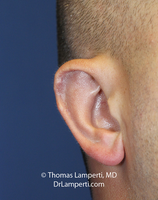 Otoplasty patient 8 right Stahl ear repair 2 months after oblique