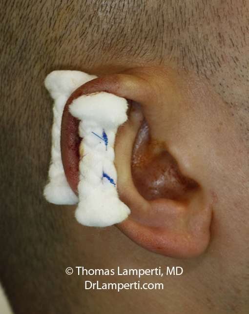 Otoplasty patient 8 right Stahl ear repair bolster in place