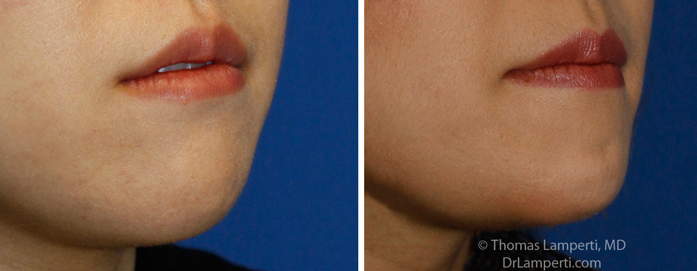 Chin shortening jaw reduction patient 3 right obqlique