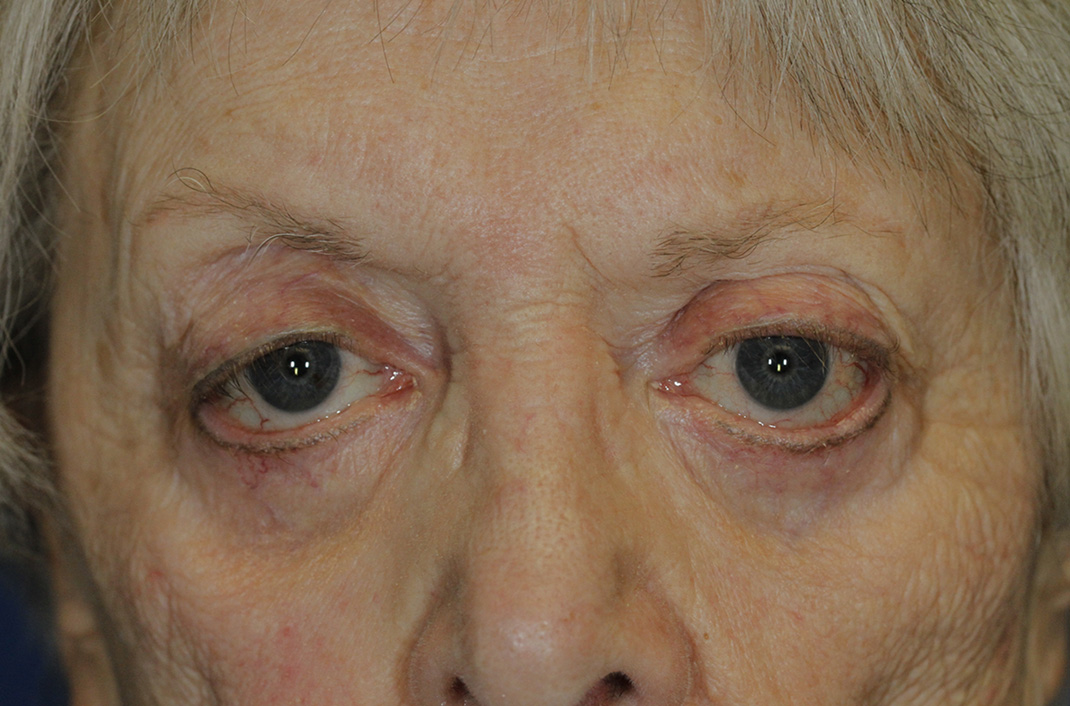 Ectropion repair patient 44 before