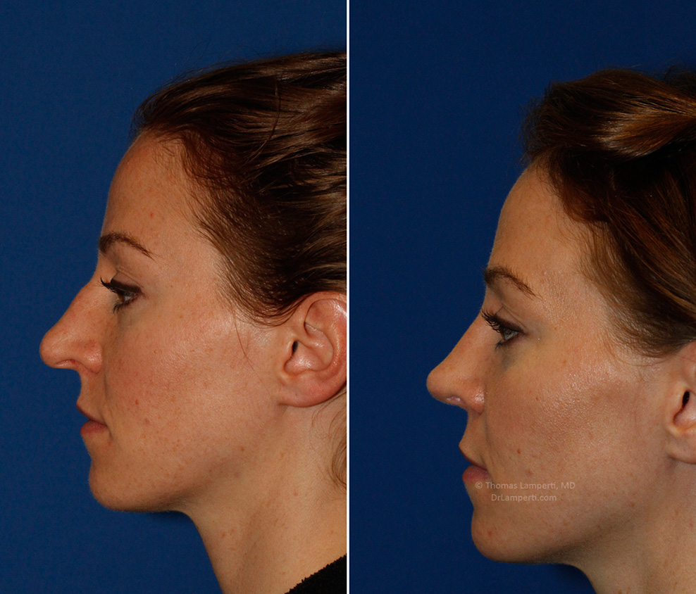 Rhinoplasty patient 53 left profile montage