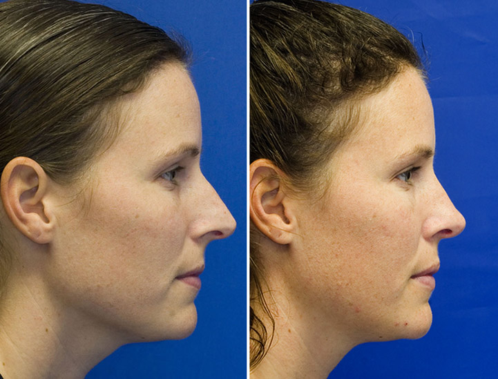 Pointy nose rhinoplasty before and after rhinoplasty photos