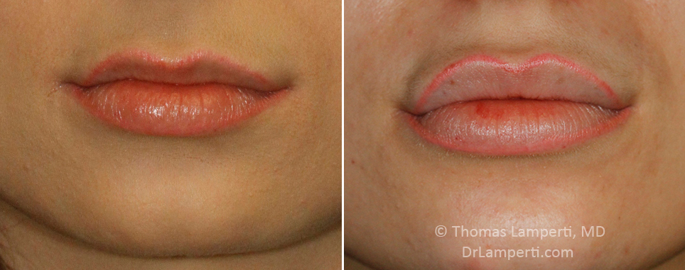 Lip Augmentation Patient 7 before and after restylane injection