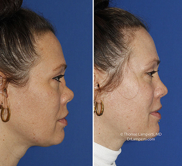 Rhinoplasty patient 71 right profile saddle nose deformity before and after photos.jpg
