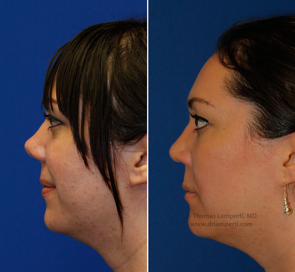 Rhinoplasty patient 46 before and after left profile upturned nose repair