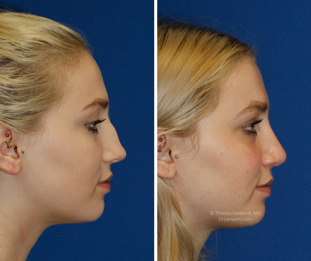 Rhinoplasty patient 54 saddle nose and bridge hump repair