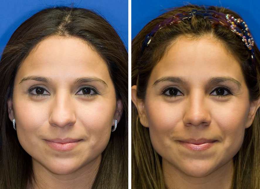 Revision Rhinoplasty in Seattle Washington