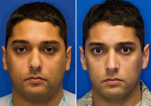 tip-ptosis-2-frontal.jpg